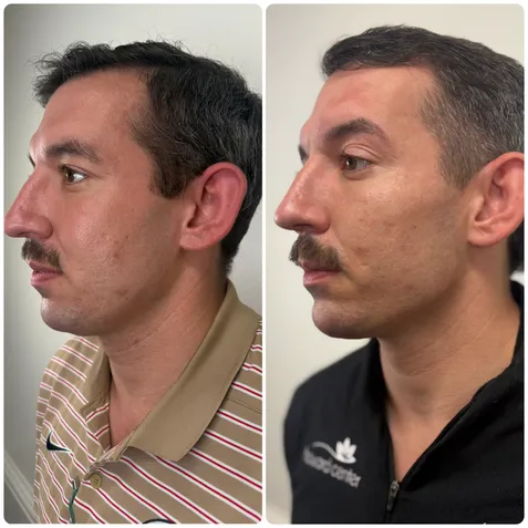 Injectable treatment before and after — jawline, chin & cheeks