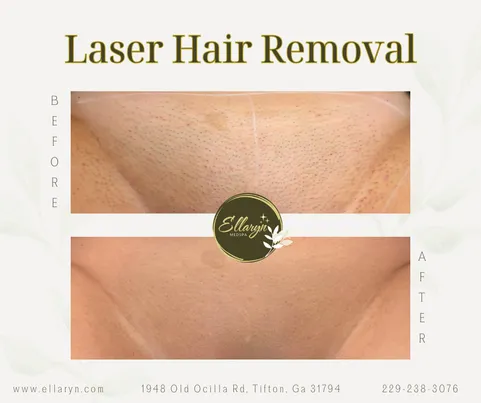 Laser hair removal before and after — results after 4 sessions