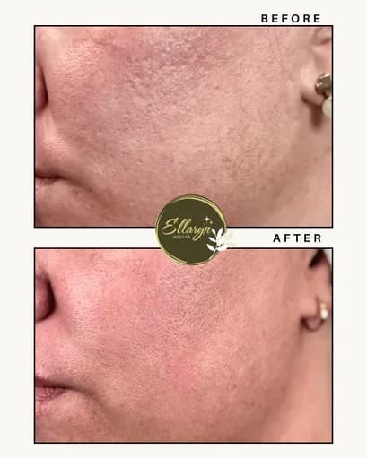 Microneedling with RF before and after — one session