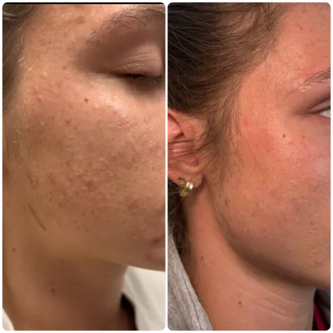 Skin revitalization before and after at Ellaryn MedSpa